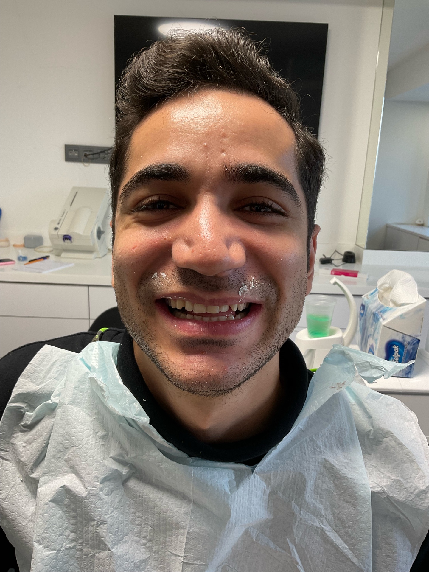 Porcelain Veneers - Mock-up Design