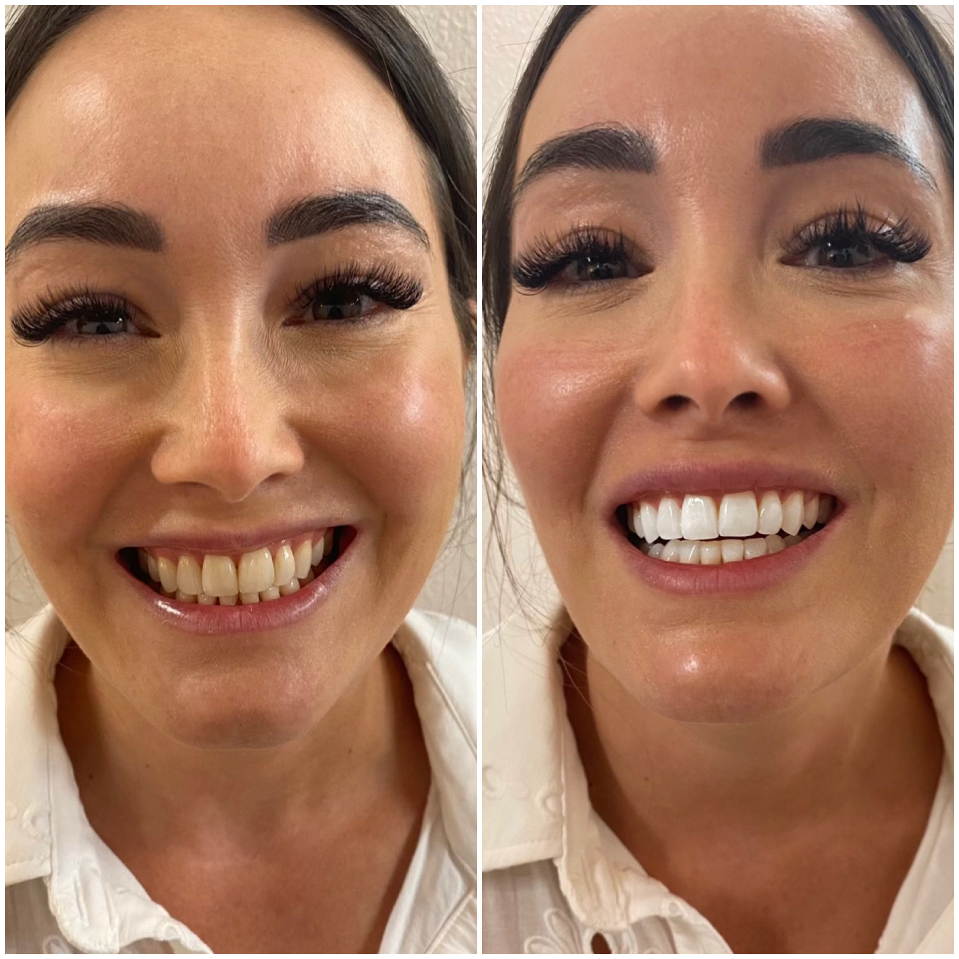 Professional Teeth Whitening Before After